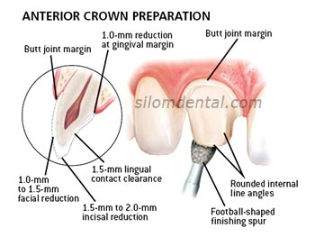 anterior e.max crown preparation