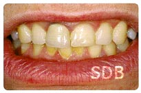 IPS e.max CAD + Ceram Crown