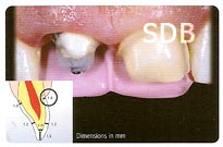 IPS e.max CAD + Ceram Crown