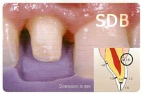 IPS e.max ZirCAD + Ceram Crown