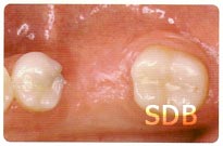 IPS e.max ZirCAD + ZirPress inlay-retained bridge