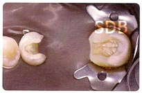 IPS e.max ZirCAD + ZirPress inlay-retained bridge