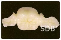 IPS e.max ZirCAD + ZirPress inlay-retained bridge