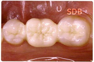 IPS e.max ZirCAD + Ceram Crown