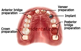 e max all ceramic crown veneer bridge implant