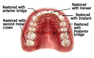 e max all ceramic crown veneer bridge implant