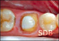 IPS e.max crown step by step