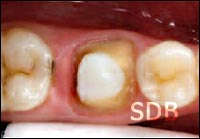 IPS e.max crown step by step