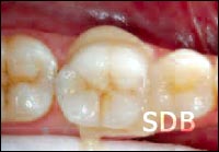 IPS e.max crown step by step