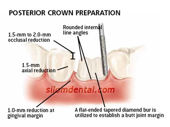 prosterior e.max crown preparation