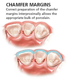 ips emax veneer tooth preparation