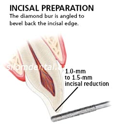 e.max veneer tooth preparation