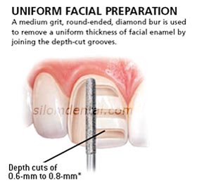 e max veneer tooth preparation