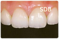 e.max veneers