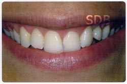 e.max veneers