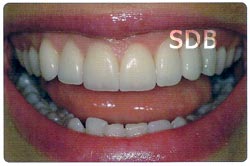 e.max veneers