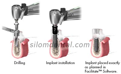 facilitate surgical procedure