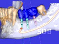 facilitate computer guided implant treatment