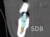facilitate computer guided implant treatment