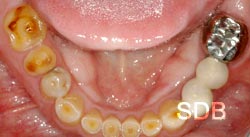 extra oral before full mouth rehabilitation