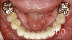 extra oral after full mouth rehabilitation