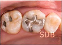 amalgum filling