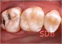 composite filling