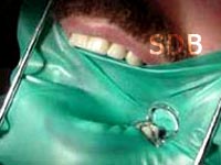 rubber dam application