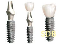 titanium implant