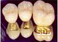poscelain fused to Precious crown