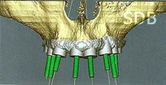 SimPlant Bone support SurgiGuide
