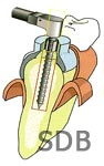 Bone-Supported-SurgiGuide