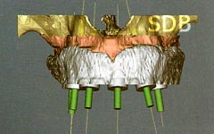 SimPlant Mucosa support SurgiGuide