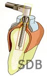 Mucosa-Supported-SurgiGuide