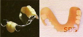 Conventional Removable Partial Denture