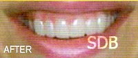 snap-on smile bangkok, snap-on smile thailand