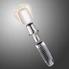 Replace Select Straight Dental Implants