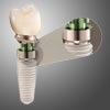 Replace Select Straight Dental Implants