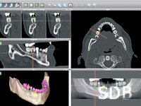 straumann guided surgery