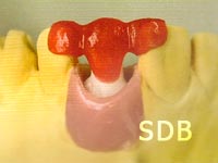 new treatment option with Roxolid implants
