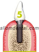 Straumann Bone Level Implant -Bone Control Design