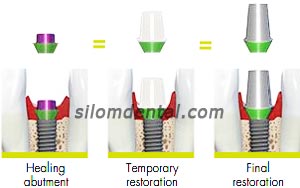 straumann bone level implant consistent emergence profiles