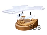 straumann scan template fabrication