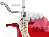 straumann straumann prosthetic procedures