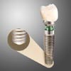 Replace SelectTapered Dental Implants