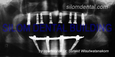 All-on-4 Implants