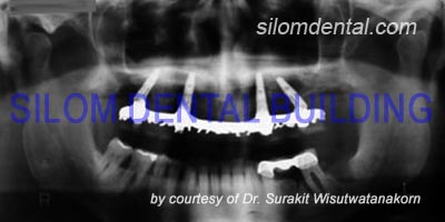All-on-4 Implants