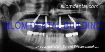 All-on-4 Implants