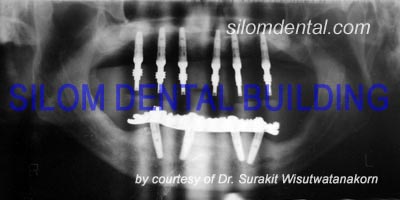 Upper All-on-6 and Lower All-on-4 Implants