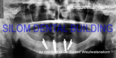 Lower All-on-4 Implants